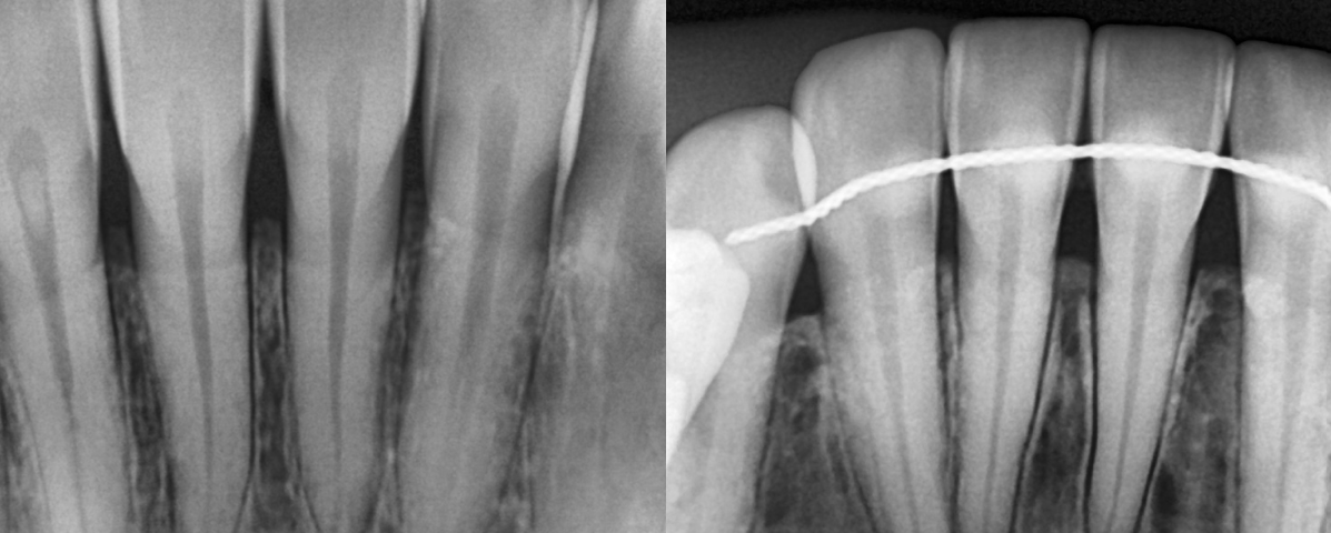 I-VIEW GOLD – CAPTEUR CMOS INTRA-ORAL